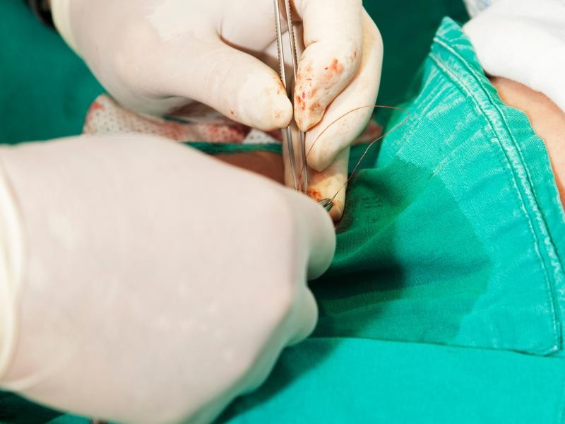 Postectomia (Cirurgia de Fimose / Circuncisão)